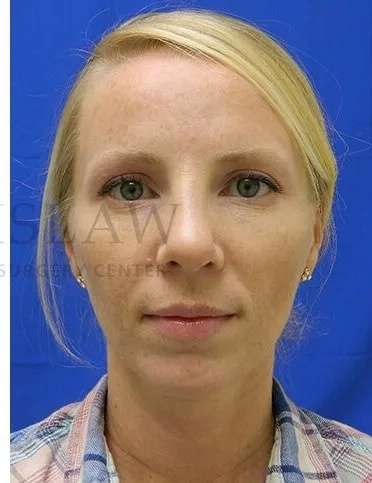 Rhinoplasty Before & After Patient #1200
