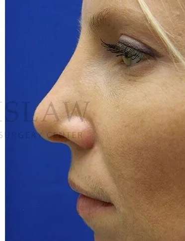Rhinoplasty Before & After Patient #1200