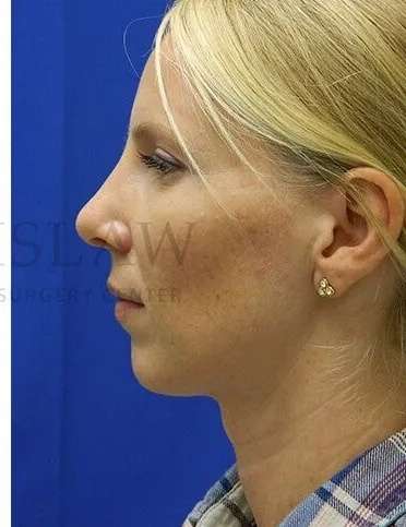 Rhinoplasty Before & After Patient #1200