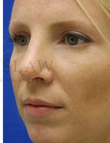 Rhinoplasty Before & After Patient #1200