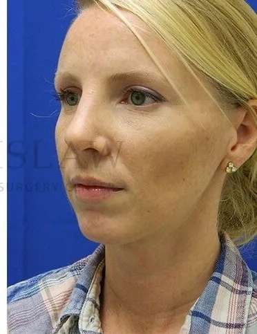 Rhinoplasty Before & After Patient #1200