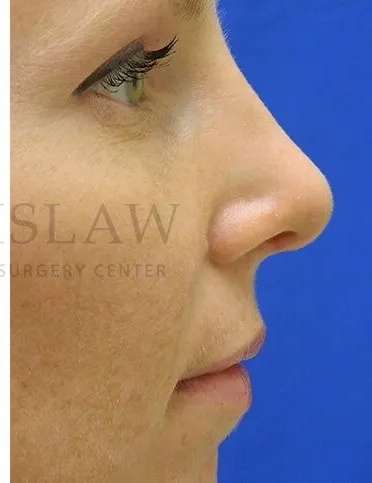 Rhinoplasty Before & After Patient #1200