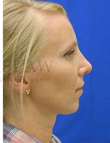 Rhinoplasty Before & After Patient #1200