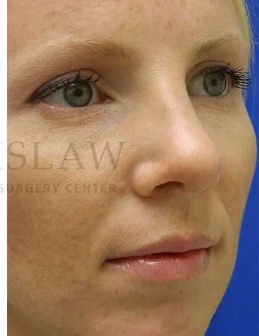 Rhinoplasty Before & After Patient #1200