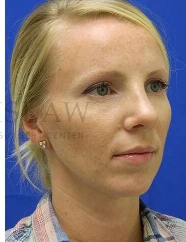 Rhinoplasty Before & After Patient #1200
