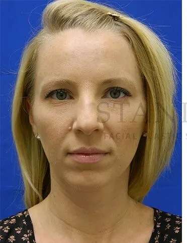 Rhinoplasty Before & After Patient #1200