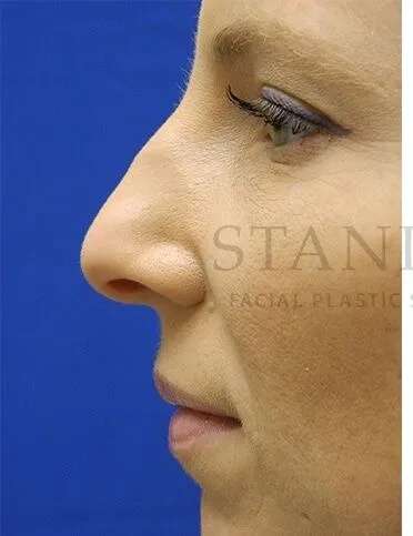 Rhinoplasty Before & After Patient #1200