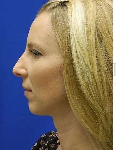 Rhinoplasty Before & After Patient #1200