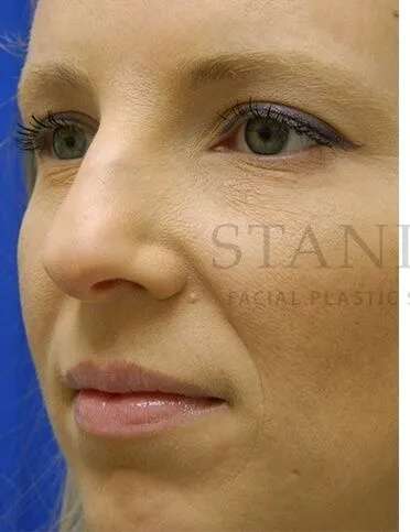 Rhinoplasty Before & After Patient #1200