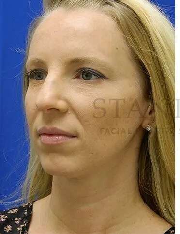 Rhinoplasty Before & After Patient #1200