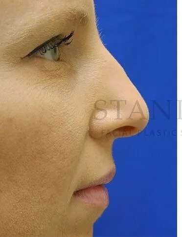Rhinoplasty Before & After Patient #1200