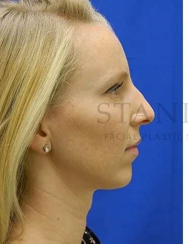 Rhinoplasty Before & After Patient #1200