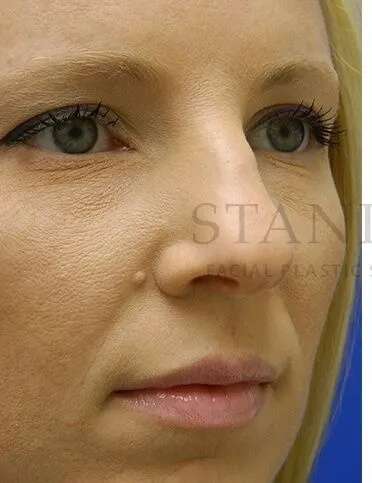 Rhinoplasty Before & After Patient #1200