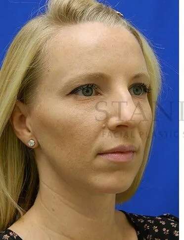 Rhinoplasty Before & After Patient #1200