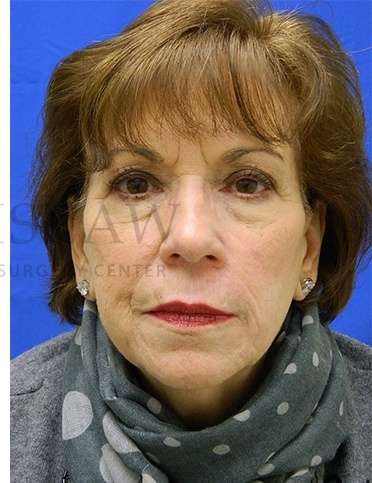 Skin Cancer Repair Before & After Patient #1324