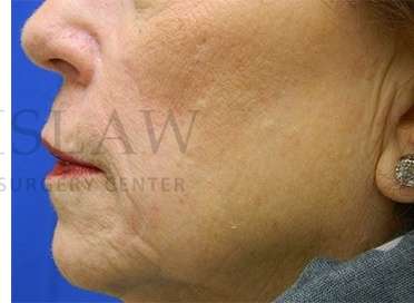 Skin Cancer Repair Before & After Patient #1324