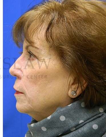 Skin Cancer Repair Before & After Patient #1324