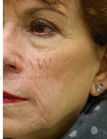 Skin Cancer Repair Before & After Patient #1324