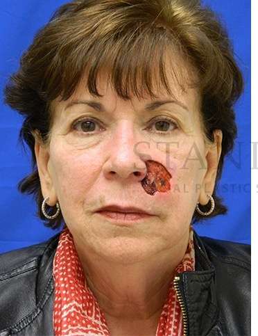 Skin Cancer Repair Before & After Patient #1324