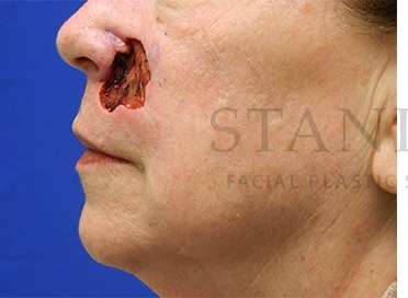 Skin Cancer Repair Before & After Patient #1324