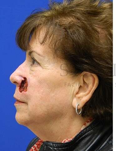 Skin Cancer Repair Before & After Patient #1324