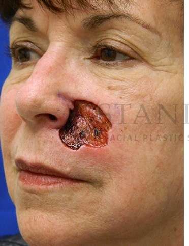Skin Cancer Repair Before & After Patient #1324
