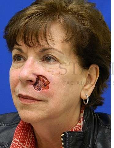Skin Cancer Repair Before & After Patient #1324