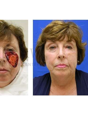 Skin Cancer Repair Before & After Patient #1331