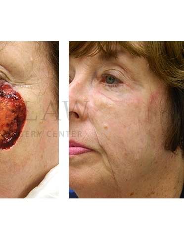 Skin Cancer Repair Before & After Patient #1331