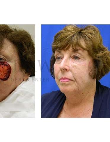 Skin Cancer Repair Before & After Patient #1331