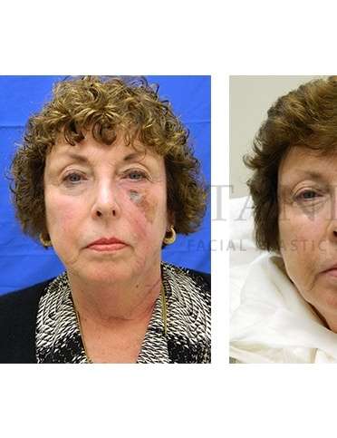 Skin Cancer Repair Before & After Patient #1331