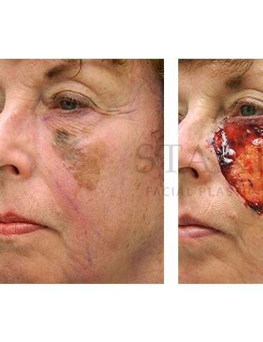 Skin Cancer Repair Before & After Patient #1331