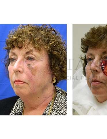 Skin Cancer Repair Before & After Patient #1331