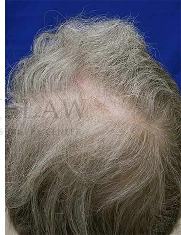 Skin Cancer Repair Before & After Patient #1313