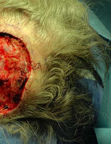 Skin Cancer Repair Before & After Patient #1313