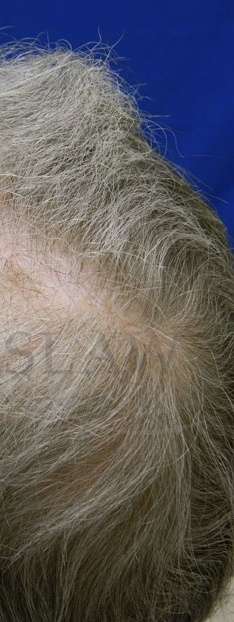 Skin Cancer Repair Before & After Patient #1313