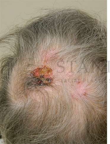 Skin Cancer Repair Before & After Patient #1313