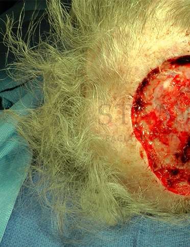 Skin Cancer Repair Before & After Patient #1313