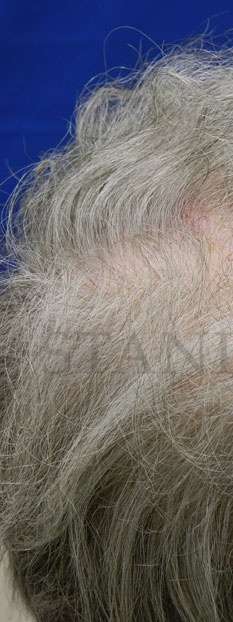 Skin Cancer Repair Before & After Patient #1313