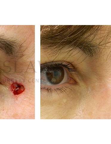 Skin Cancer Repair Before & After Patient #1306