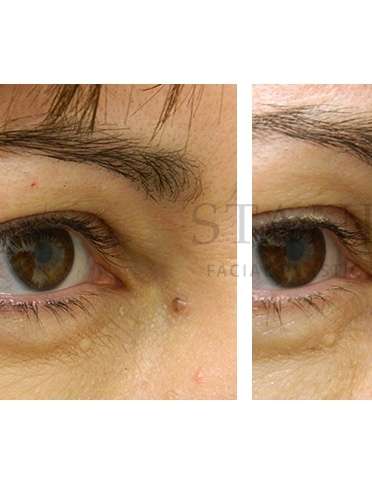 Skin Cancer Repair Before & After Patient #1306