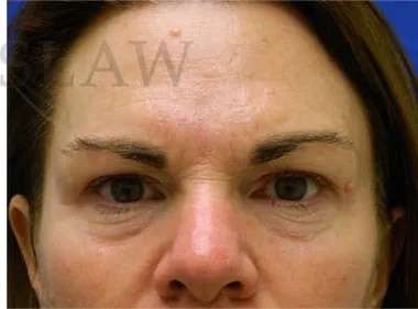 Skin Care Before & After Patient #1344