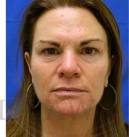 Skin Care Before & After Patient #1344