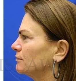Skin Care Before & After Patient #1344