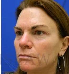 Skin Care Before & After Patient #1344