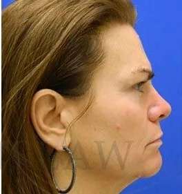 Skin Care Before & After Patient #1344
