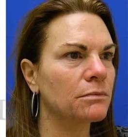 Skin Care Before & After Patient #1344