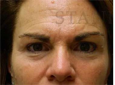 Skin Care Before & After Patient #1344