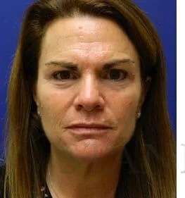 Skin Care Before & After Patient #1344
