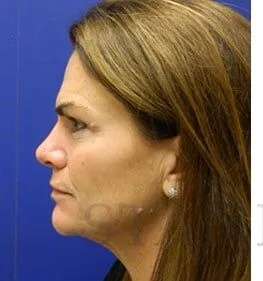 Skin Care Before & After Patient #1344
